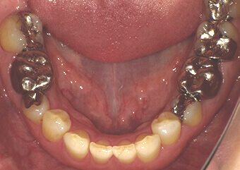 被せ物　施術前