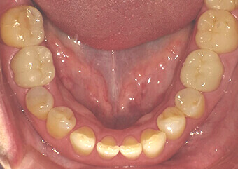 被せ物　施術後