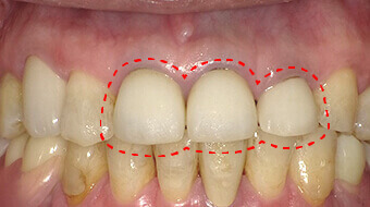 被せ物　施術前