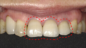 被せ物　施術後