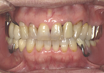 一般的な設計の入れ歯（保険適用）
