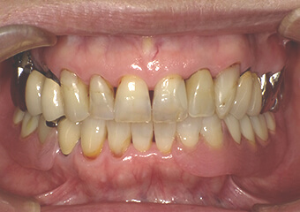 金属のバネのない入れ歯(正面)