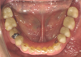 金属のバネのない入れ歯(下顎)